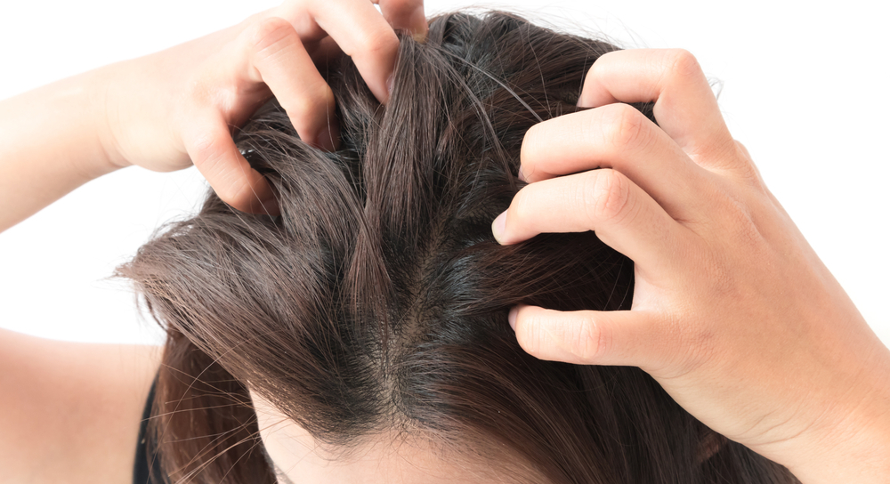 Flaky scalp syndrome 5 Unconventional Hair problem people face 